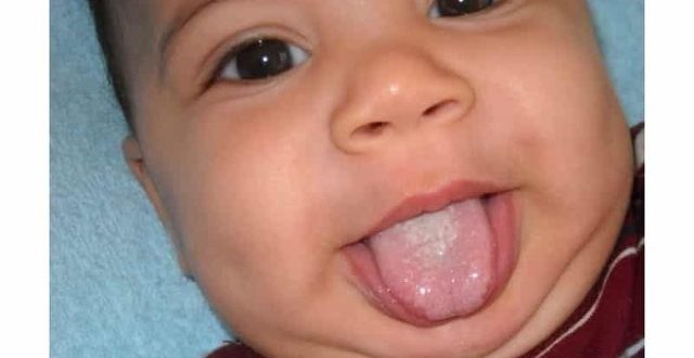 Молочница у девочки 3 годика