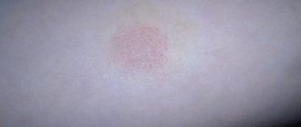 Что за шелушащееся пятно на бедре?