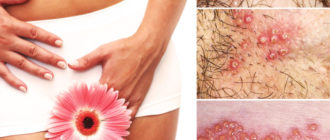 Чешется в интимном месте после чистки замершей беременности