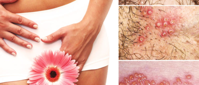 Чешется в интимном месте после чистки замершей беременности