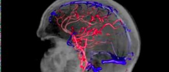 Венозная дисциркуляция в системе глубоких вен головного мозга