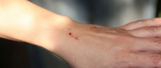 Мышь поцарапала руку