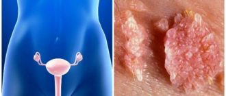 На внутренней половой губе у влагалища ощущается шероховатость. Был зуд.