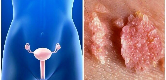 На внутренней половой губе у влагалища ощущается шероховатость. Был зуд.