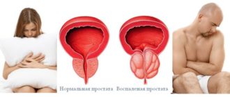 Молочница и простатит