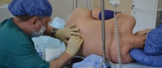 Во время беременности делала наркоз пропофолом