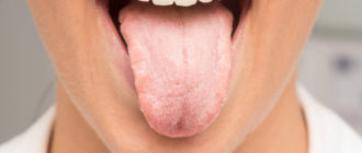 Воспаление в ротовой полости