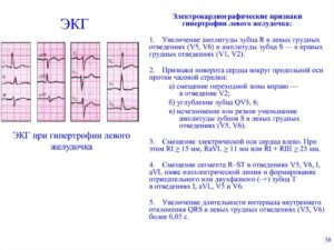 ЭКГ при гипертонической болезни