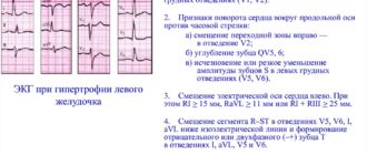 ЭКГ при гипертонической болезни