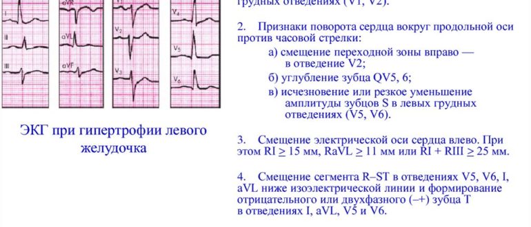 ЭКГ при гипертонической болезни