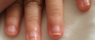 Красная полоса на ногте у ребенка