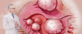 Эко при кистах и миоме