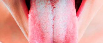 Налет на языке, и красные шарики