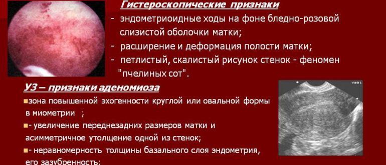 Выбор ОК при аденомиозе 1 степени