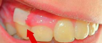 Выделения из десны, гной
