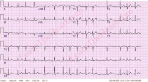Мерцательная аритмия после 2-х месяцев установки кардиостимулятора