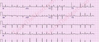 Мерцательная аритмия после 2-х месяцев установки кардиостимулятора