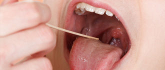 Наросты в горле