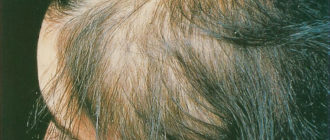 Выпадают волосы при тиреотоксикозе