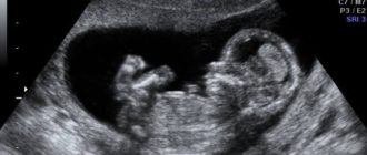 Узи 13 недель