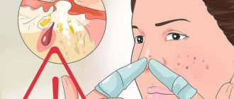 Выдавил прыщ