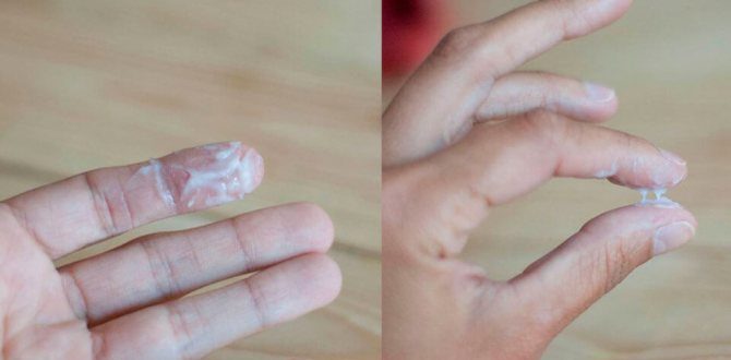 Метрогил побочные реакции, густые белые выделения