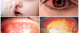 Вирусный конъюнктивит у ребенка в 2 года