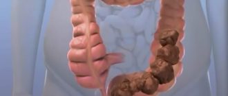 Вялый каловый живот