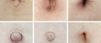 В пупке образование синюшного цвета