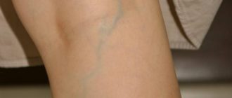 Вены на ногах стали видны