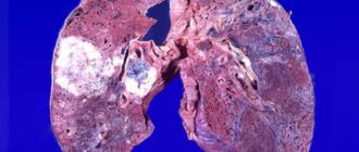 Возможен рак лёгкого
