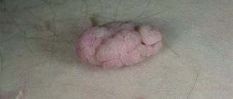 Нарост на соске во время беременности