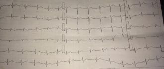 Возможна гипертрофия правого желудочка. Пульс 144