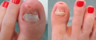 Чем обработать ногтевое ложе после удаления ногтя, был грибок