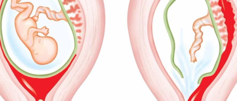 На пол дня утихают месячные, а потом заливной момент