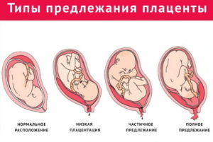 Краевое предлежание плаценты на 23 неделе