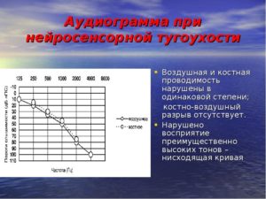 Временное улучшение слуха при нейросенсорной тугоухости