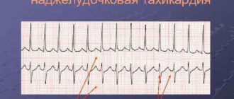 Наджелудочковая тахикардия