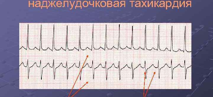 Наджелудочковая тахикардия