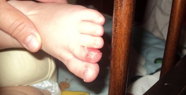 Водянистые пузыри на ручках и ножках у ребенка
