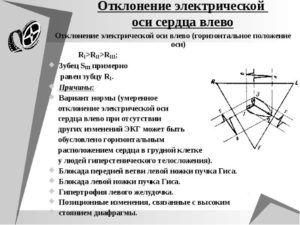 Эос отклонена влево у ребёнка