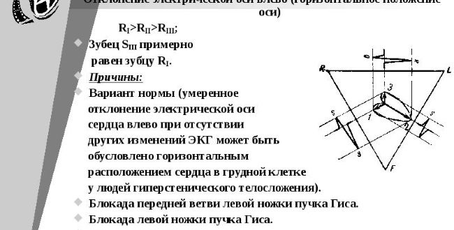 Эос отклонена влево у ребёнка