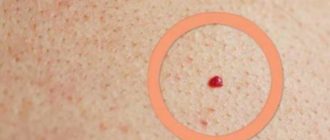 Много родинок у ребенка 9 лет