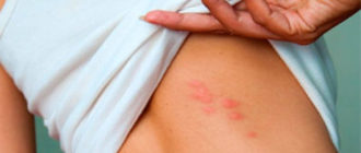 Чешусь незнаю что кусает