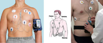 Волнение во время холтер мониторинга