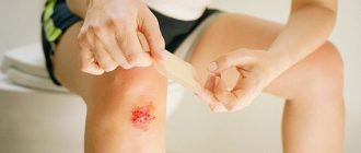 Мокнущая рана