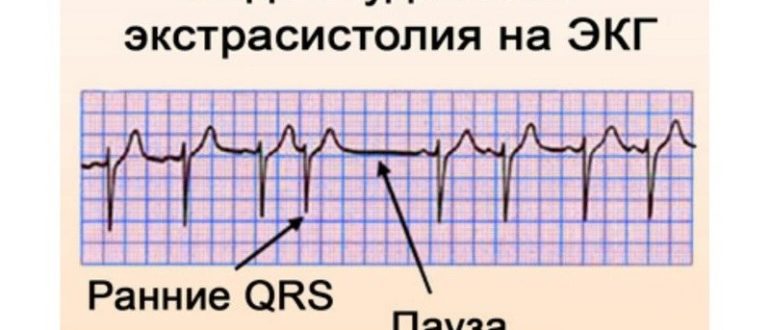 Мучает экстрасистолия