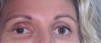 Через 7 дней после удара нос болит и отекает