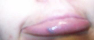 Чёрный бугорок на внутренней стороне большой половой губы