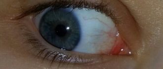 Воспаление внутреннего уголка глаза?